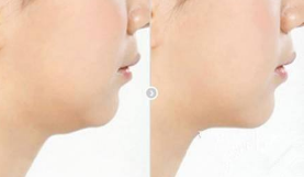 治疗下巴短小后缩型双下巴效果