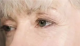 自然老化形成的眼角纹
