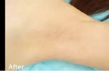 腋下脱毛后