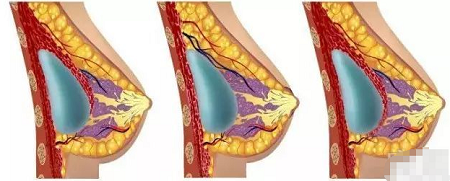 隆胸假体植入位置