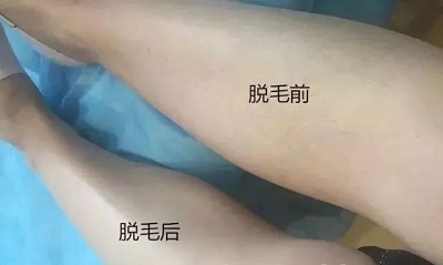 腿部脱毛效果对比