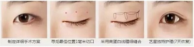 艺星双眼皮增大手术