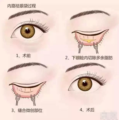 内路去眼袋法
