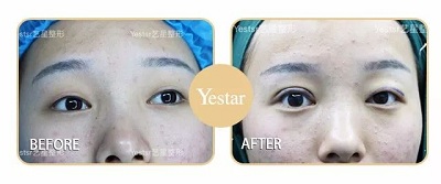 双眼皮手术后效果