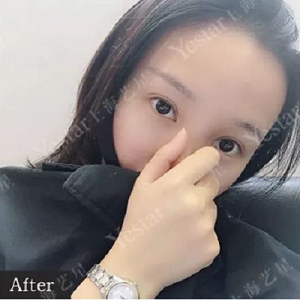 双眼皮手术之后的我