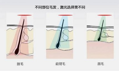 脱毛的原理