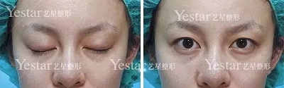 双眼皮手术之前的样子