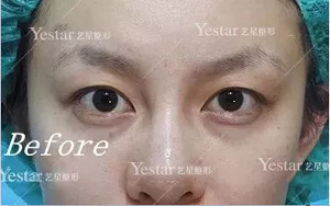 双眼皮手术之前