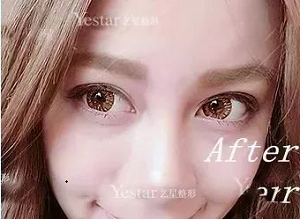 双眼皮手术之后超好看