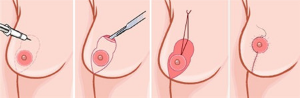 乳房下垂矫正