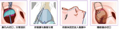 假体隆鼻的过程