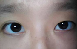 眼睛一大一小,是不是属于上睑下垂?