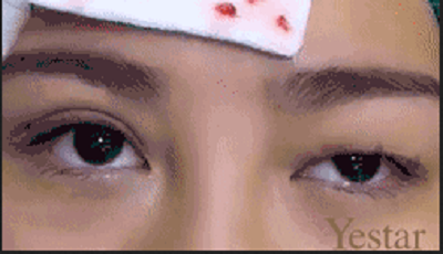 割双眼皮去眼脂肪