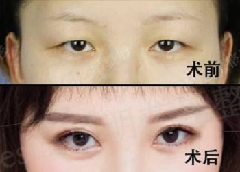 双眼皮眼手术后效果特写