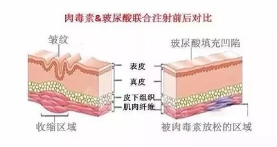 玻尿酸和除皱