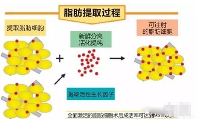 自体脂肪移植的成活率