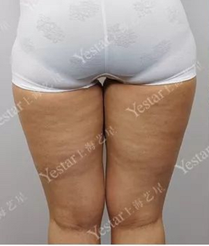 大腿吸脂之前粗