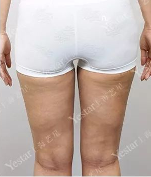 大腿吸脂之后变瘦了