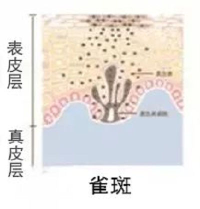 激光祛斑原理