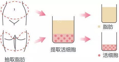 自体脂肪填充原理
