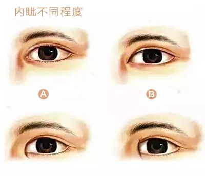内眦赘皮的各种