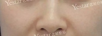 祛斑之后效果很好