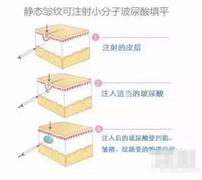 大分子和小分子玻尿酸