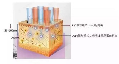 皮秒嫩肤亮白