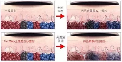 皮秒效果更强力