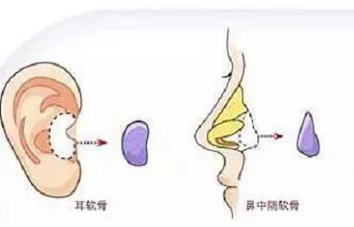 自体软骨隆鼻材料