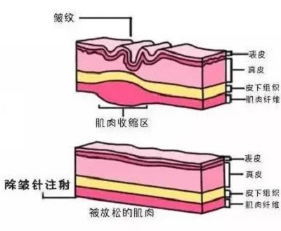 除皱的原理