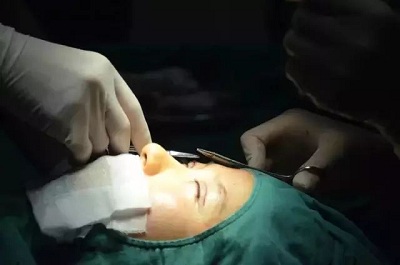 双眼皮手术一点也不痛