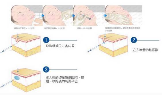 玻尿酸丰下巴效果很好