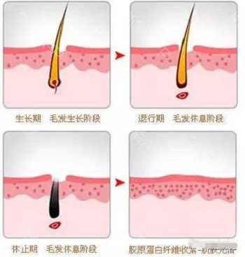 冰点激光脱毛的原理