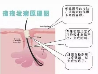 痘痘产生的原因是什么