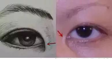 内眦赘皮眼睛不好看