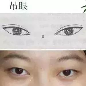 吊眼难看可以割双眼皮
