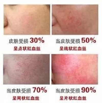 红血丝应该尽早治疗