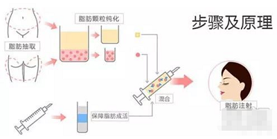 自体脂肪移植垫下巴