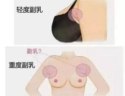 严重的副乳必须及时切除