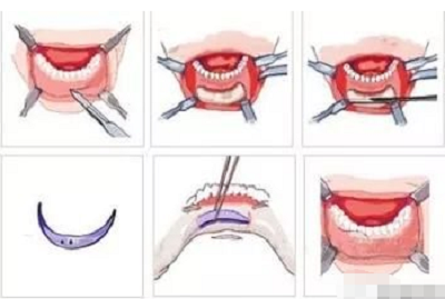 硅胶垫下巴效果永久吗