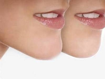 硅胶隆下巴假体会位移吗