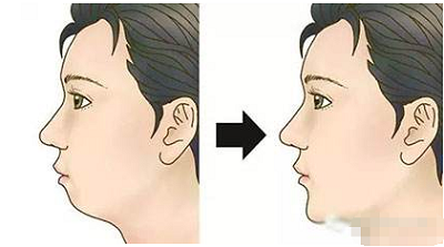 硅胶垫下巴的效果对比