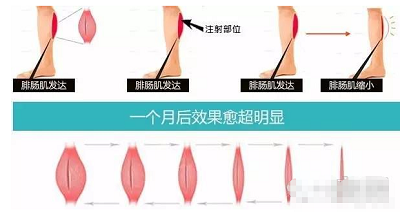 瘦腿的见效和维持时间
