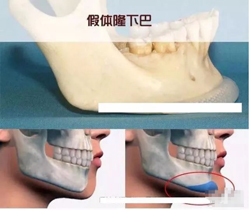 假体垫下巴的图示