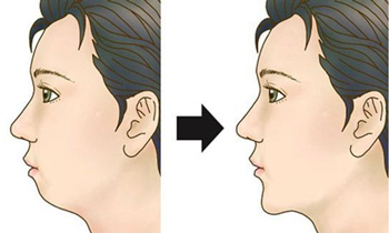 垫下巴的效果很好