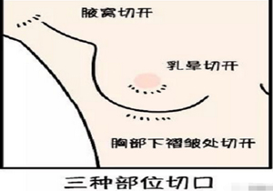 假体隆胸的手术切口