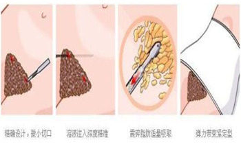 腰腹吸脂的原理过程