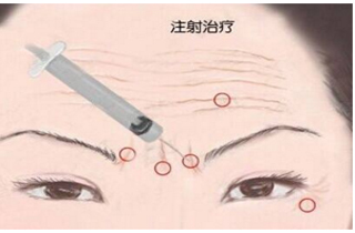 眼周皱纹除皱