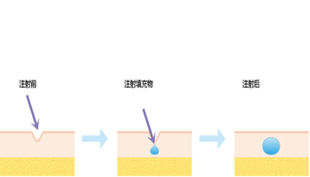 除皱的原理过程